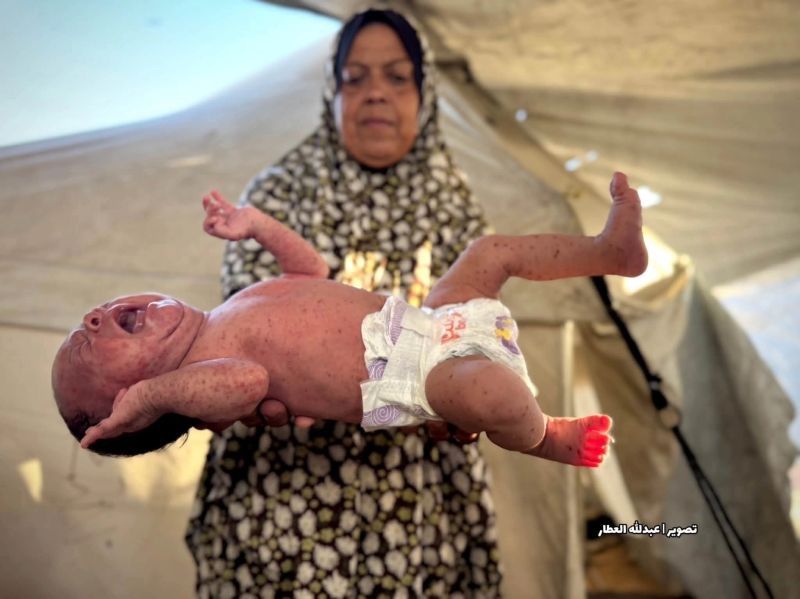 أزمة صحية متفاقمة في غزة.. انتشار جدري الماء بين النازحين