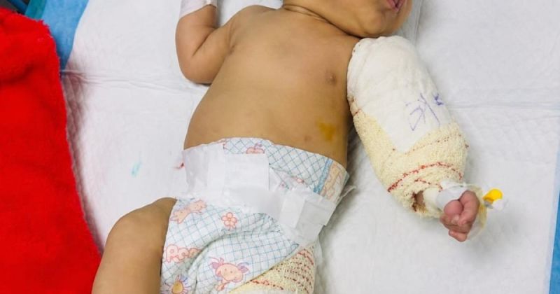 الرضيع محمد الخطيب.. فقد أمه وساقه اليسرى قبل أن يتعلم المشي
