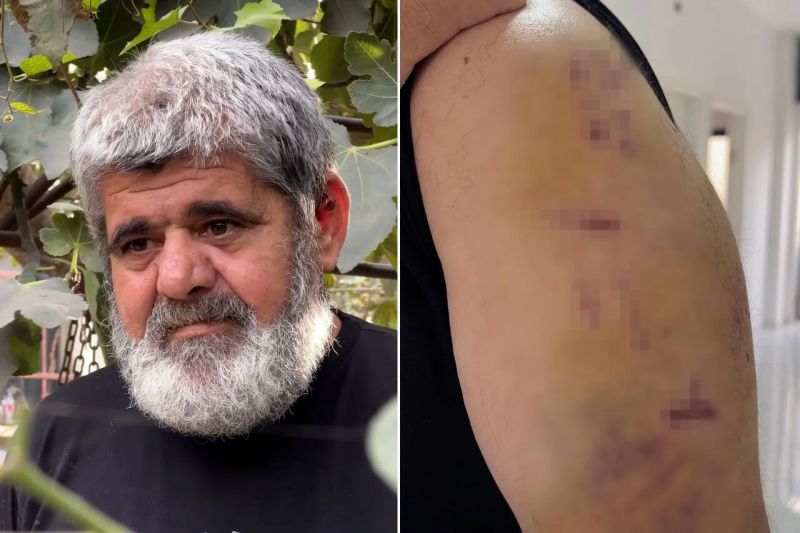 50 غرزة في الرأس.. مسن فلسطيني يروي تفاصيل اعتداء وحشي للمستوطنين في نابلس
