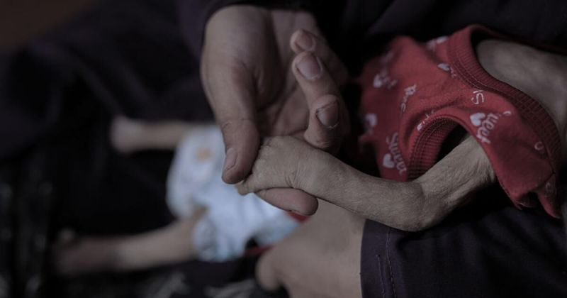 حصيلة صادمة.. سوء التغذية يفتك بمئات الفلسطينيين في غزة وتوقعات بتفاقم المجاعة