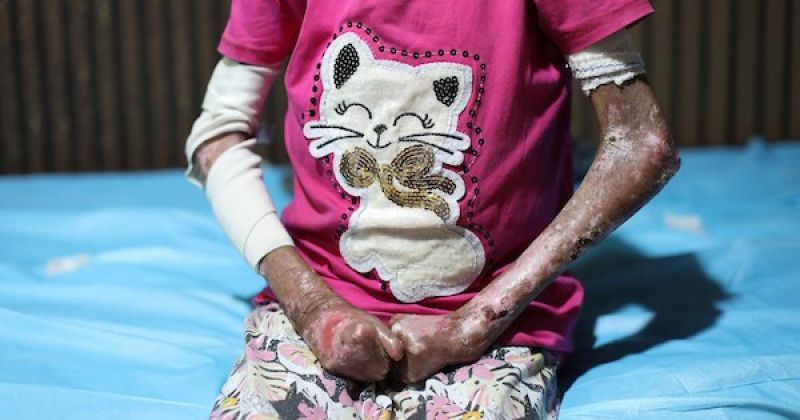 سندس تواجه «جلد الفراشة» وسوء التغذية وسط أزمة صحية متفاقمة في غزة