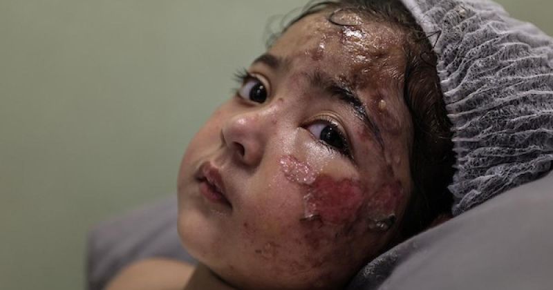 وُلدت يتيمة الأب وفقدت أمها بالقصف.. مريم تواجه الحروق ووحشة الفقد في غزة