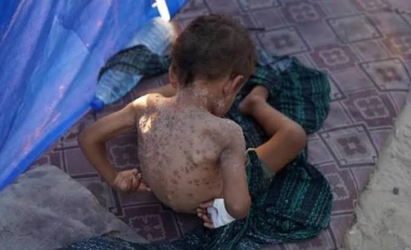 "أونروا": 125 ألف إصابة بالتهابات جلدية في غزة بين يناير ومايو