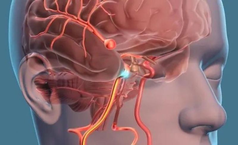 دراسة: توسّع شرايين الدماغ وراء السكتات وليس انسدادها
