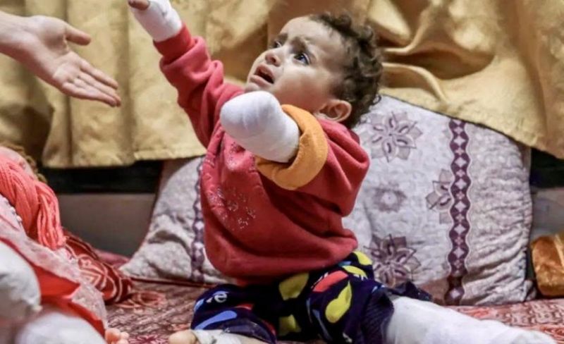 مبتورون بغزة.. ضحايا بين نخز البلاتين وشلل الشريان الطبي