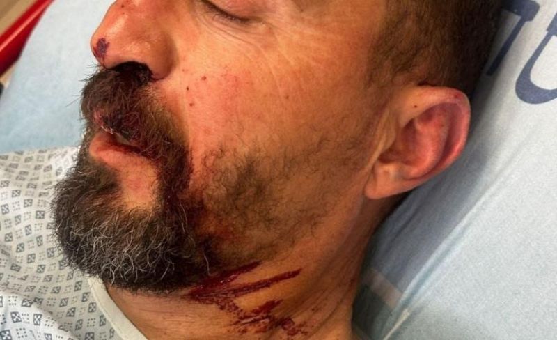 إصابة مقدسي باعتداء مستوطن عليه في جبل المكبر